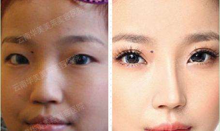 曲靖双眼皮整形美容