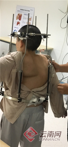 云南45岁以下贫困脊柱畸形患者可申请救助 最高达5万元
