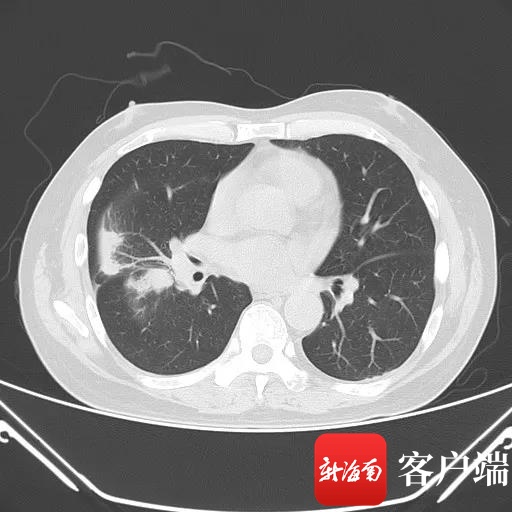 海南博鳌乐城引进国际新药劳拉替尼 为晚期肺癌患者再续“生命”