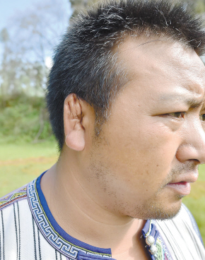 的大儿子因为摔跤的激烈对抗,导致耳朵变形,也就是常说的"摔跤耳"