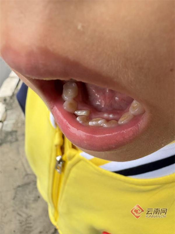 呼声回应｜昆明7岁女童被拔错了牙！谁之过错？